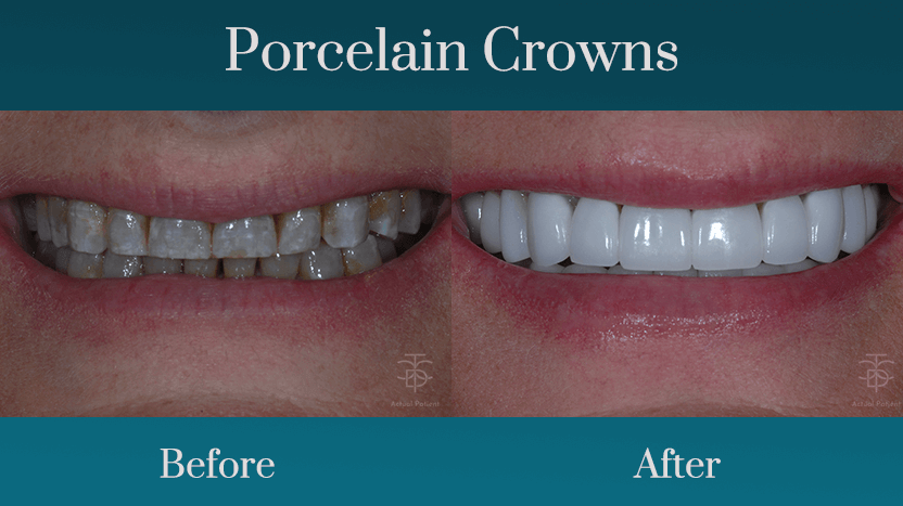 smile makeover before and afte